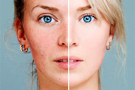 Rosacea treatment in delhi