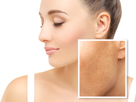 Best treatment for melasma on face