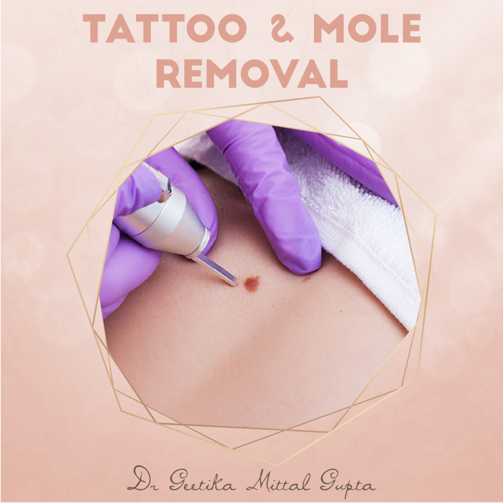 Tattoo & Mole Removal