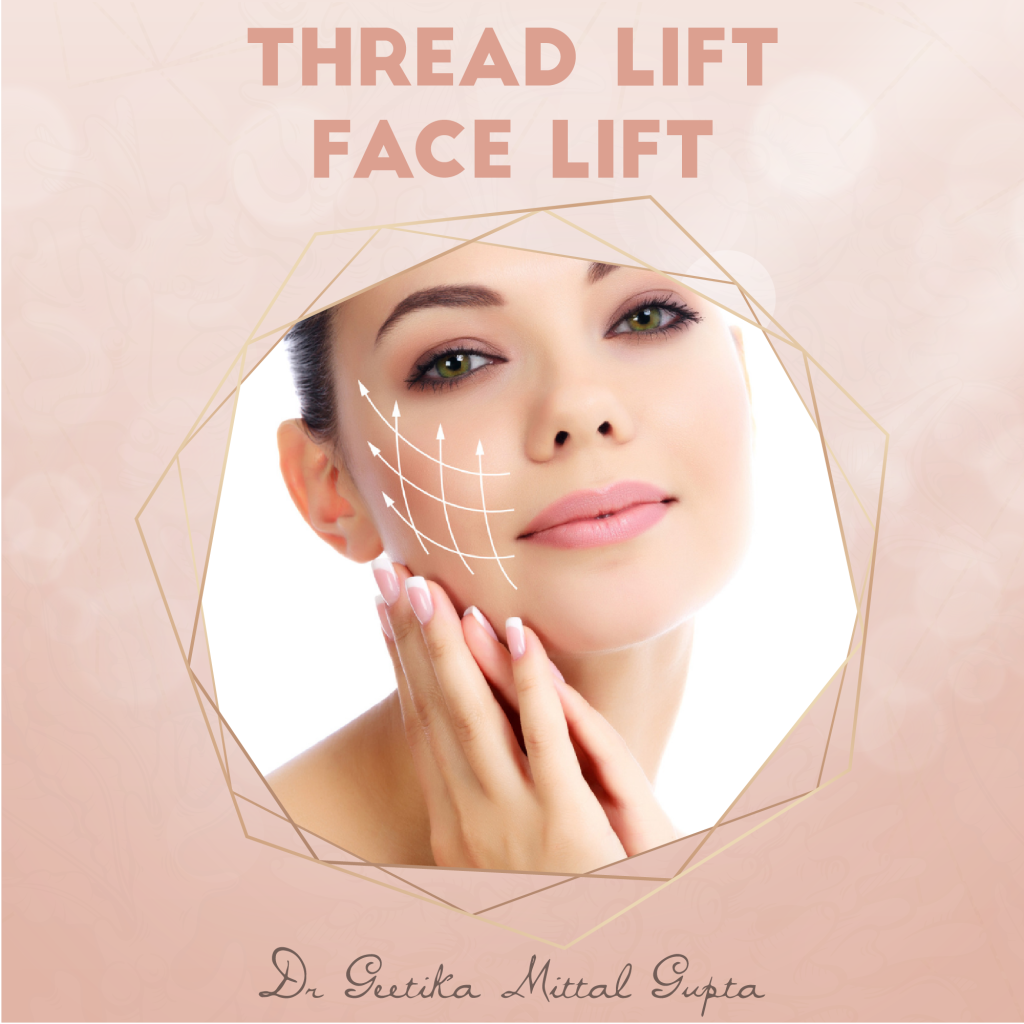 Thread Lift - Face Lift