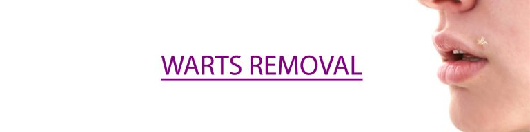 WARTS REMOVAL IN DELHI