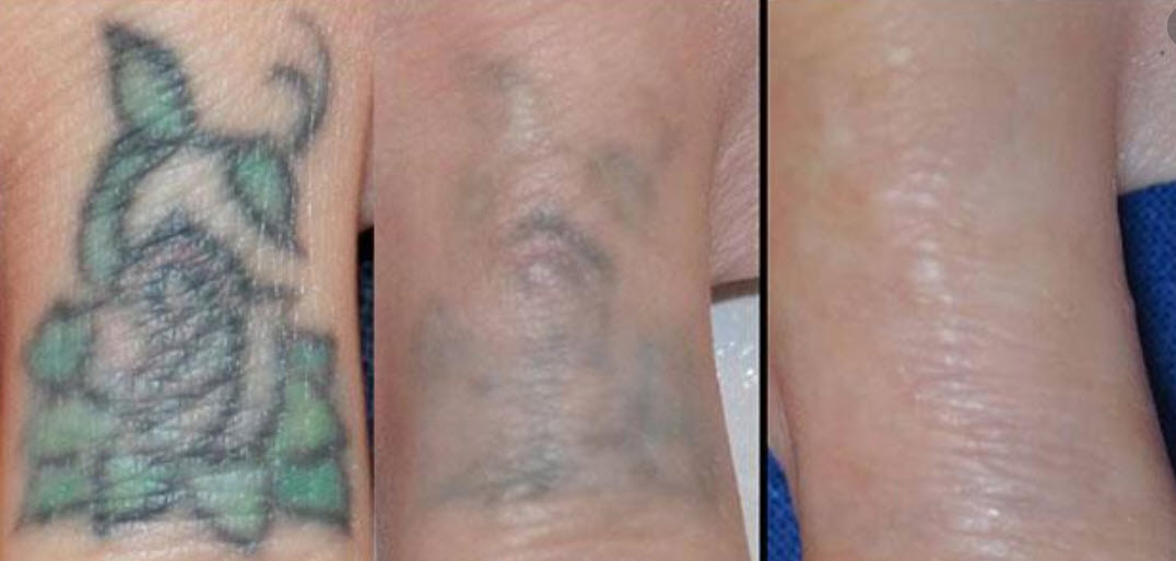 Tattoo Removal Understanding The PicoWay Laser  Blush Beverly Hills
