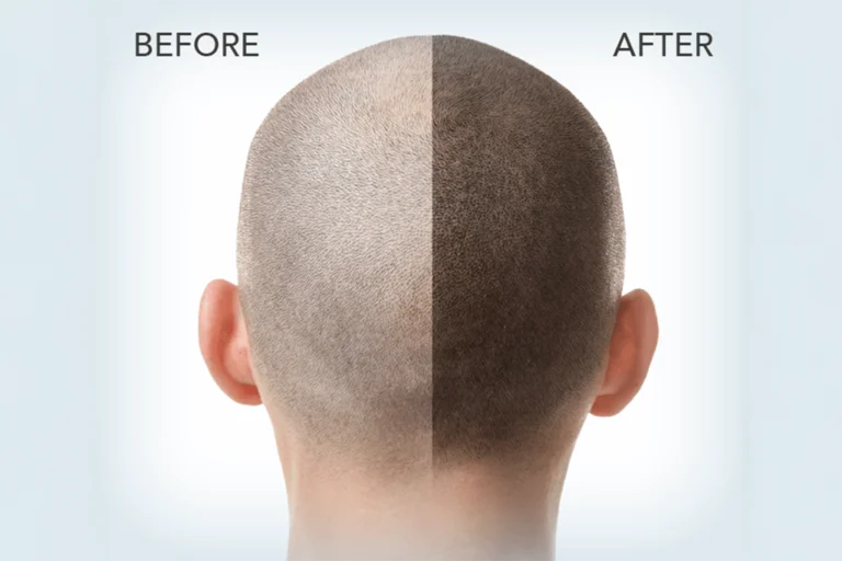 FUE Hair Transplant: Modern Solution for Hair Loss at ISAAC Luxe