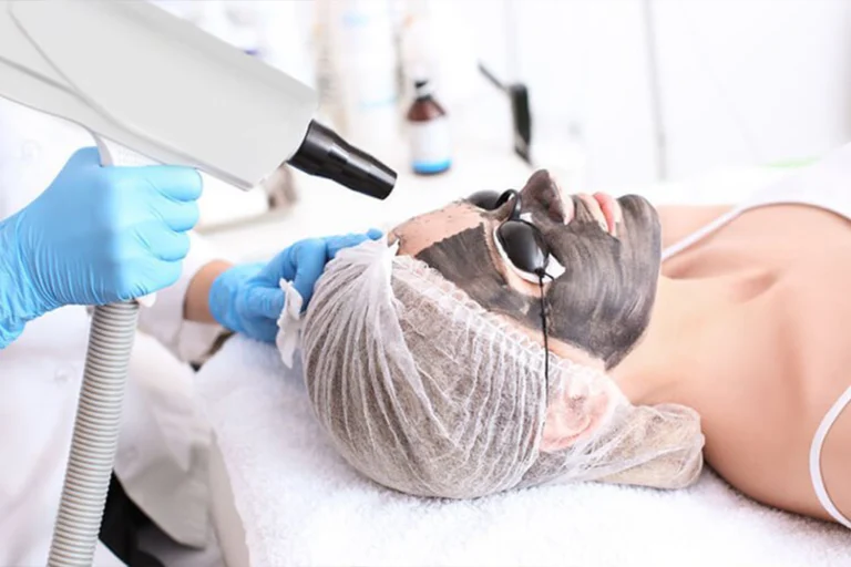 Carbon Laser Facial in Delhi