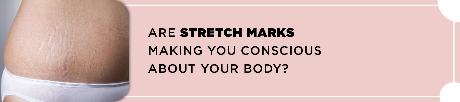 stretch marks treatment