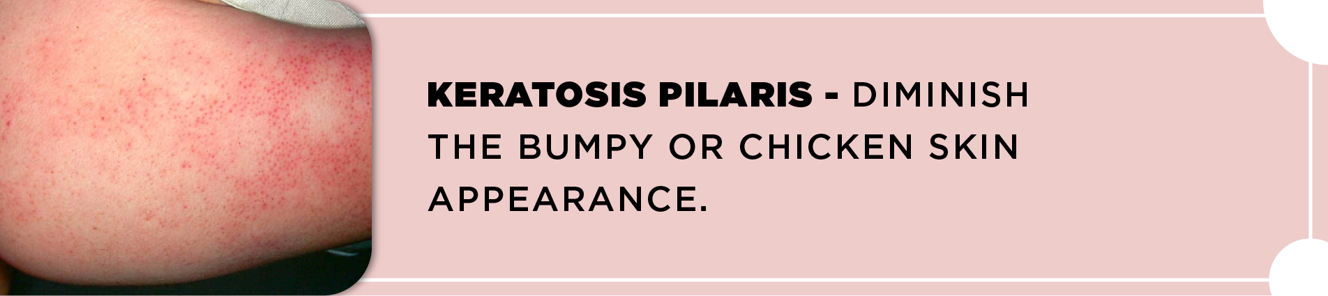 keratosis pilaris treatment