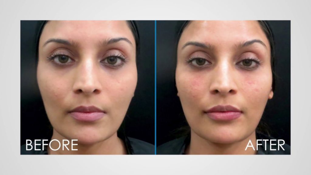 Non-Surgical Facelift in Mumbai
