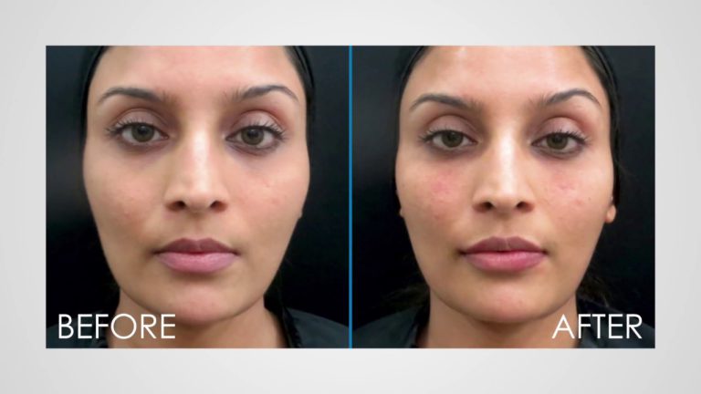 Non-Surgical Facelift in Mumbai