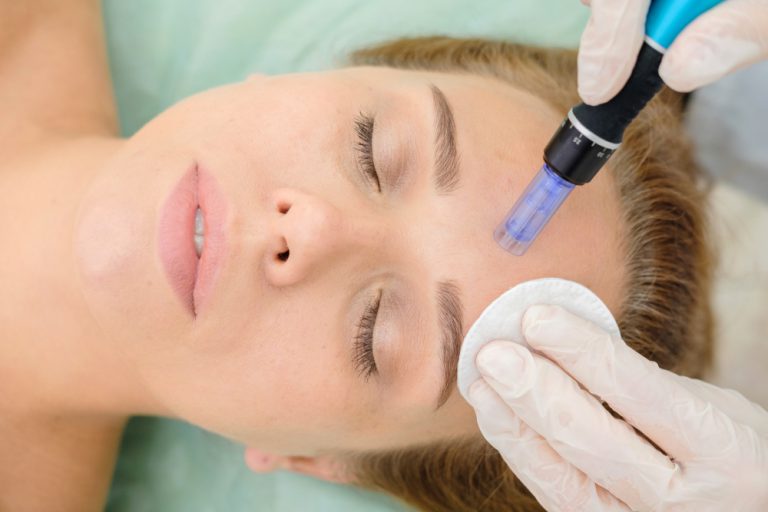 Microneedling treatment process