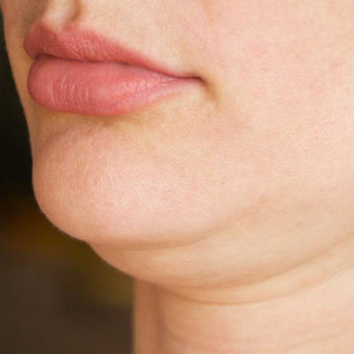 double chin treatment