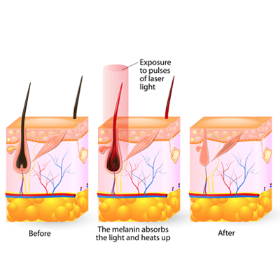 laser treatment