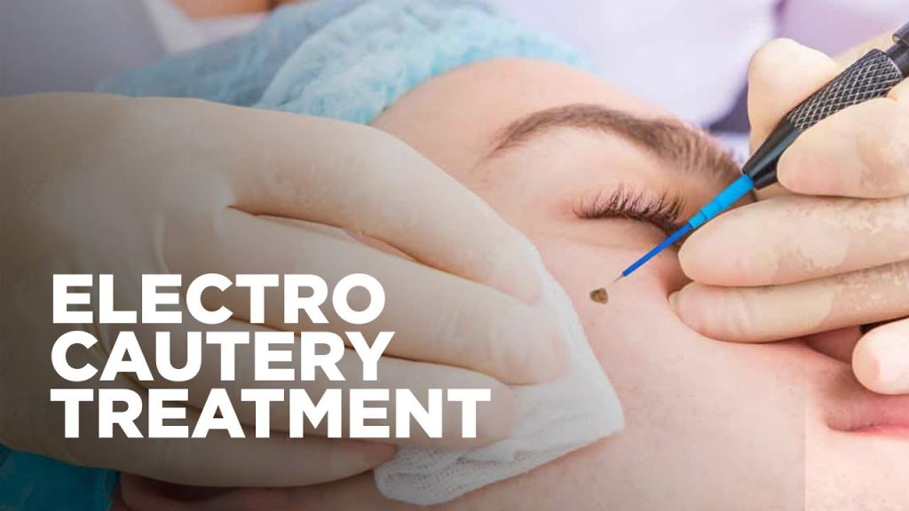 Electrocautery Treatment in Delhi / Mumbai / Gurgaon / Gurugram