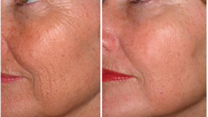 Anti Ageing Laser Treatment