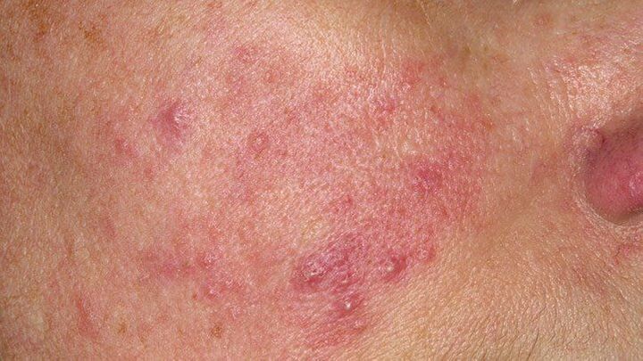How Small Skin Disease Creates Worst Condition?