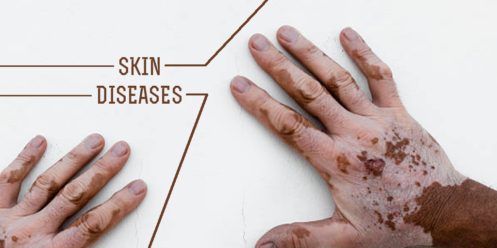 Types Of Skin Diseases