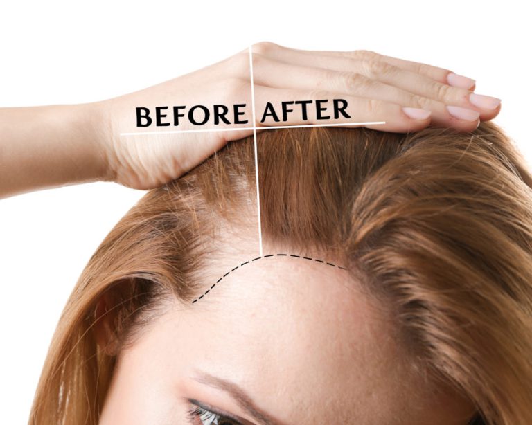 Pre and Post Treatment Care of Hair transplant