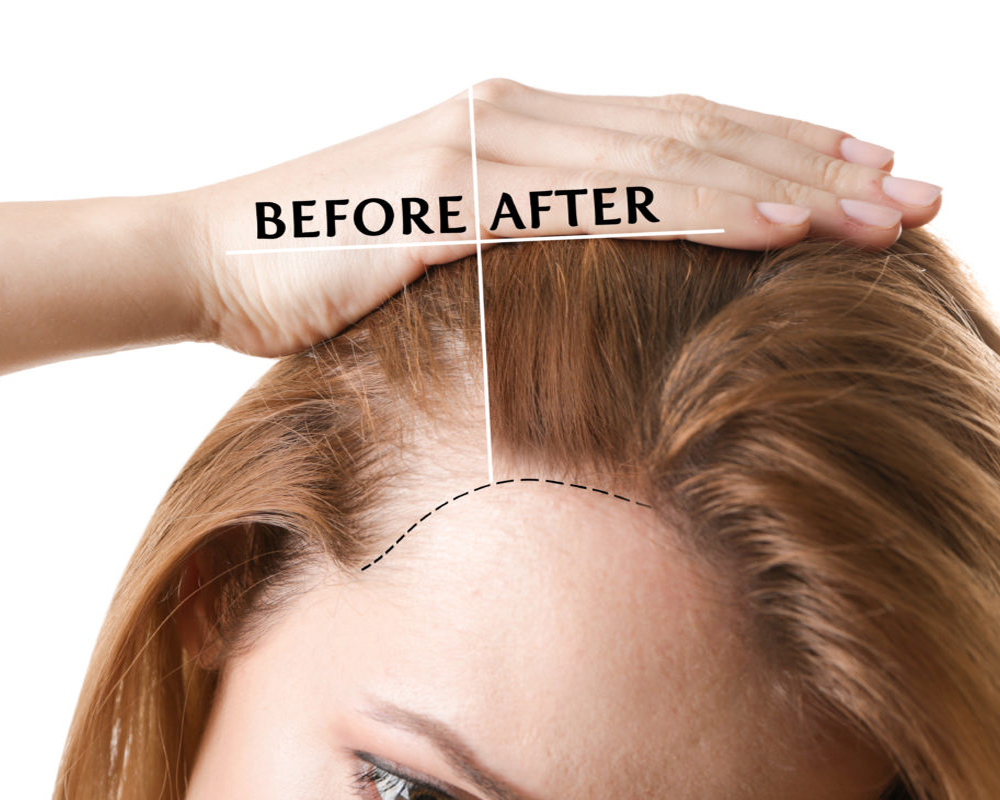 Pre and Post Treatment Care of Hair transplant - Isaac Luxe
