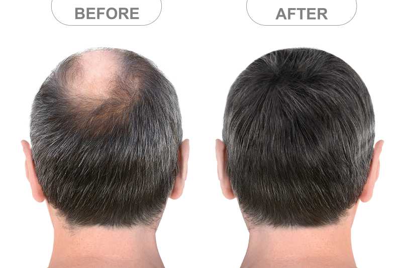 Baldness Treatment in Delhi