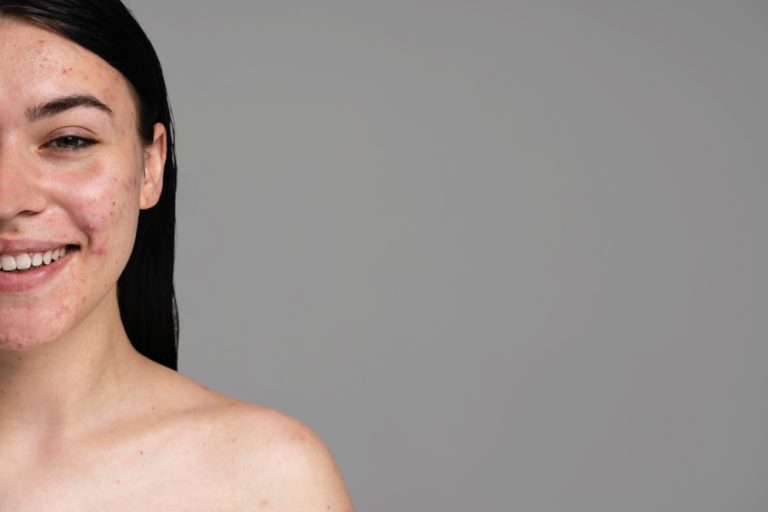 best dermatologist for acne