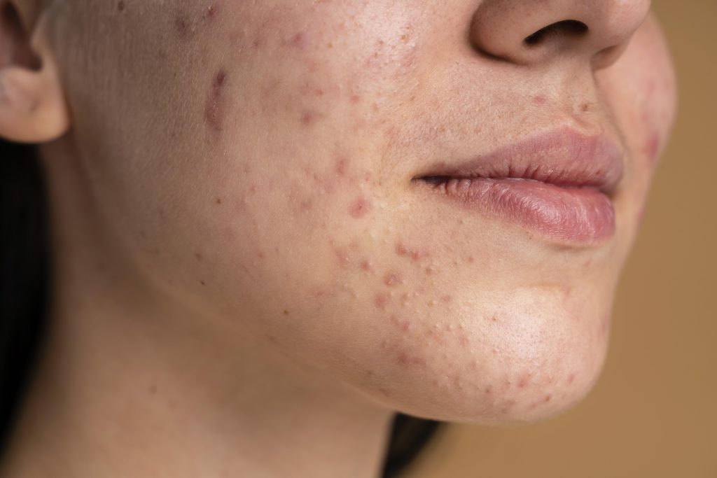 Acne treatment