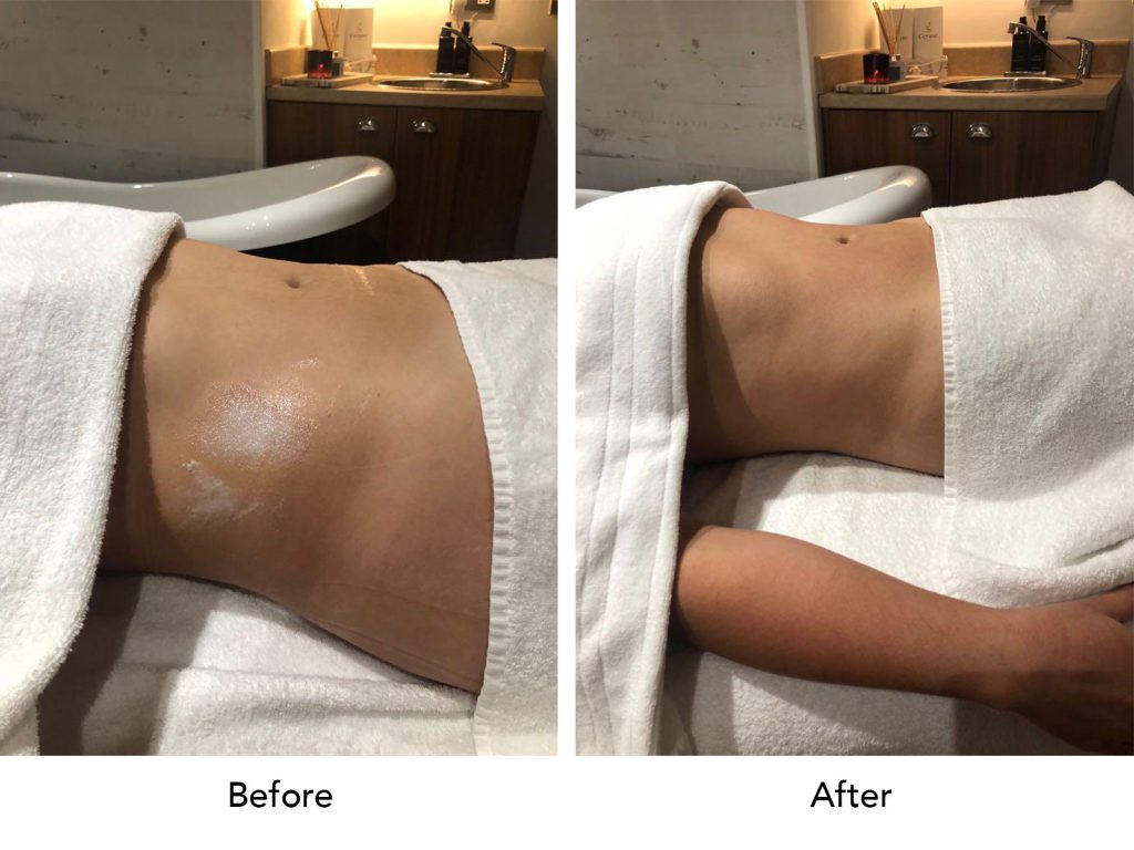 lymphatic drainage