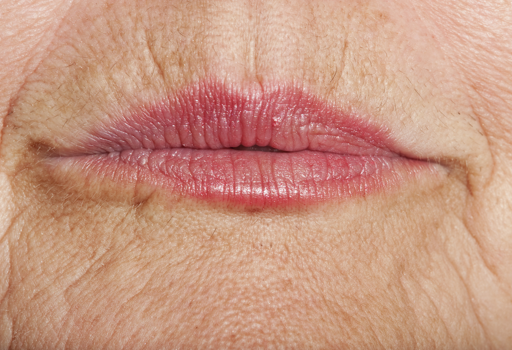 lip lines treatment