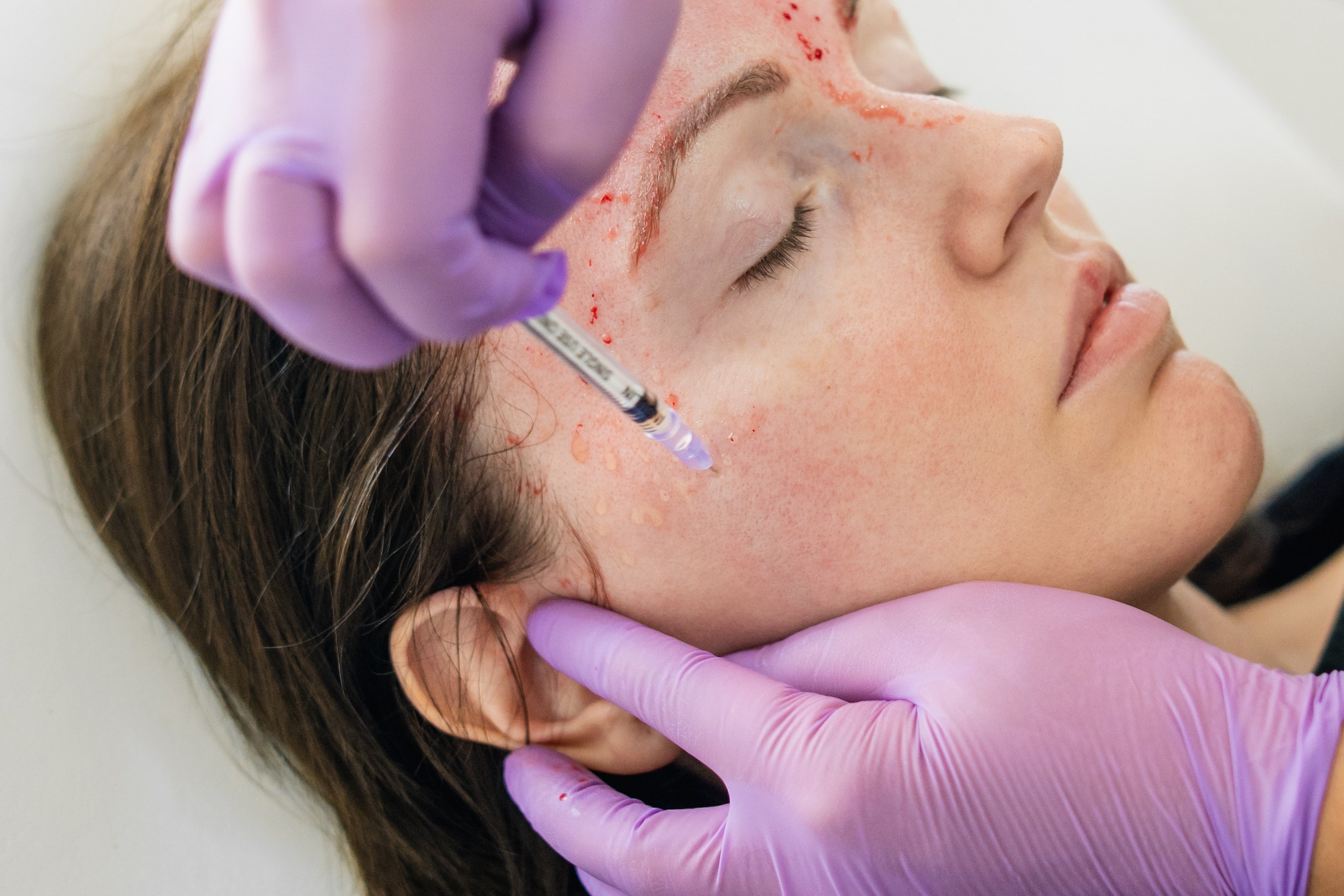 Vampire facial