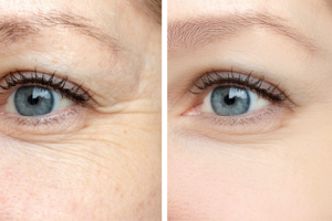 Crows Feet Treatment In Mumbai