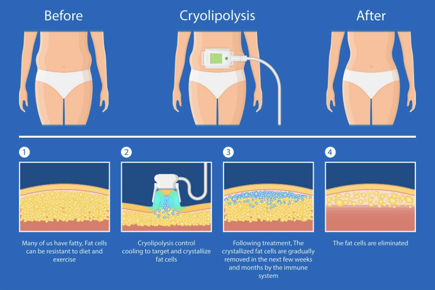 Cryolipolysis Treatment In Delhi
