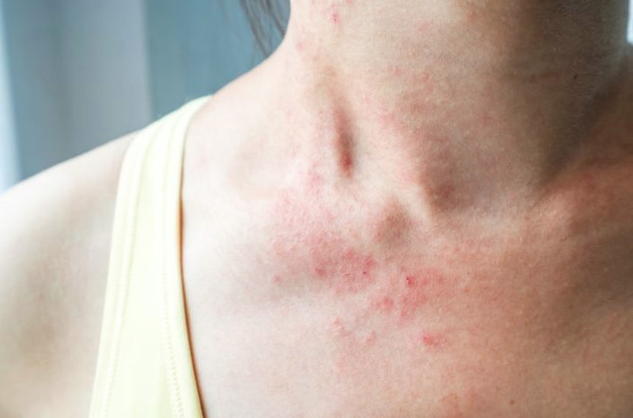 Eczema treatment in Mumbai