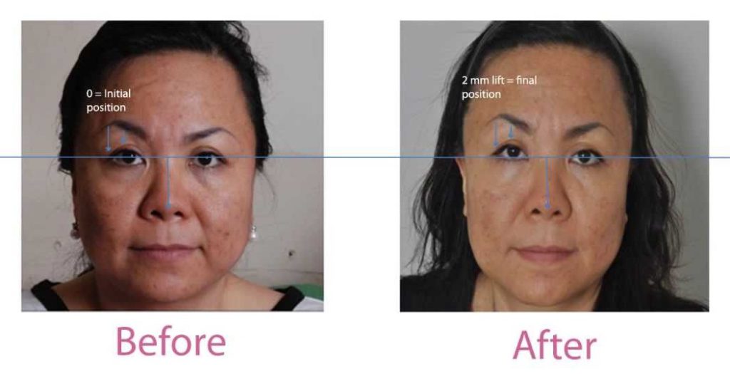 Facial Treatment