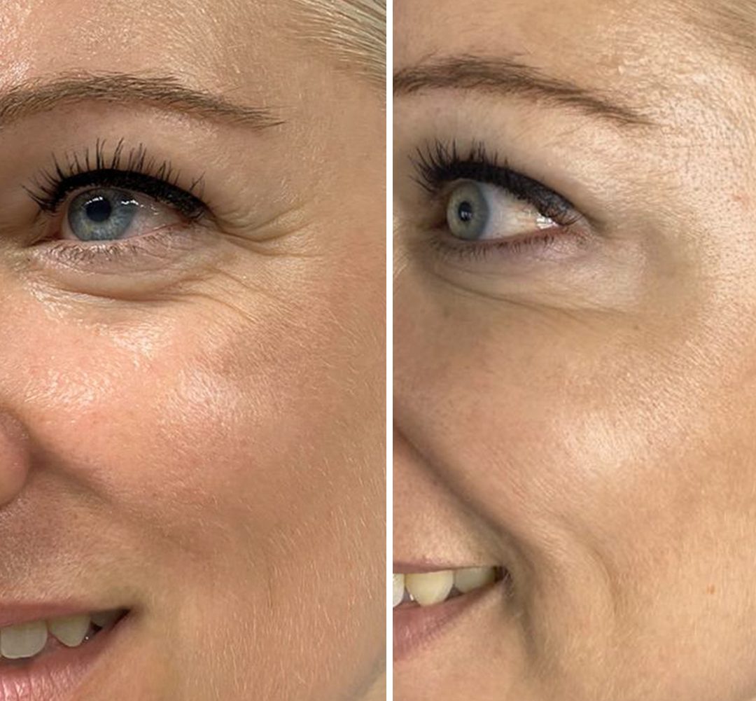 crows feet treatment Delhi