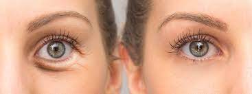 Crows Feet Treatment In Gurgaon