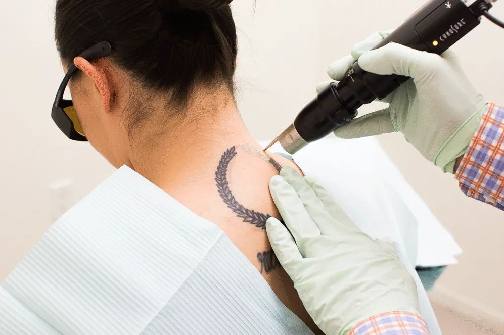 Get Tattoo Removal To Bid Goodbye To Unwanted Tattoos