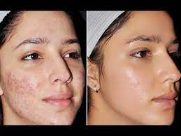 acne treatment in pune