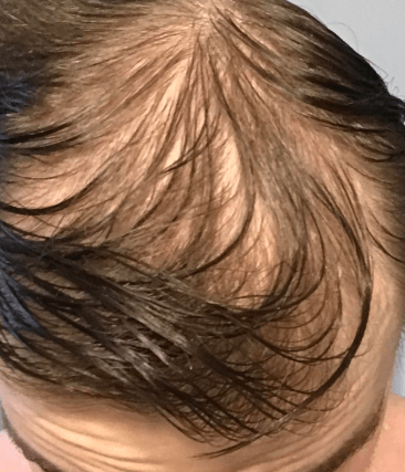 alopecia-hair-loss-treatment