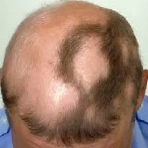 alopecia-hair-loss-treatment