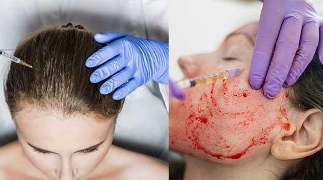 How is PRP hair treatment done