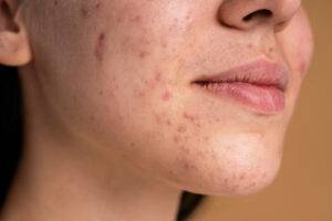 confident-young-woman-with-acne-close-up_23-2148982535