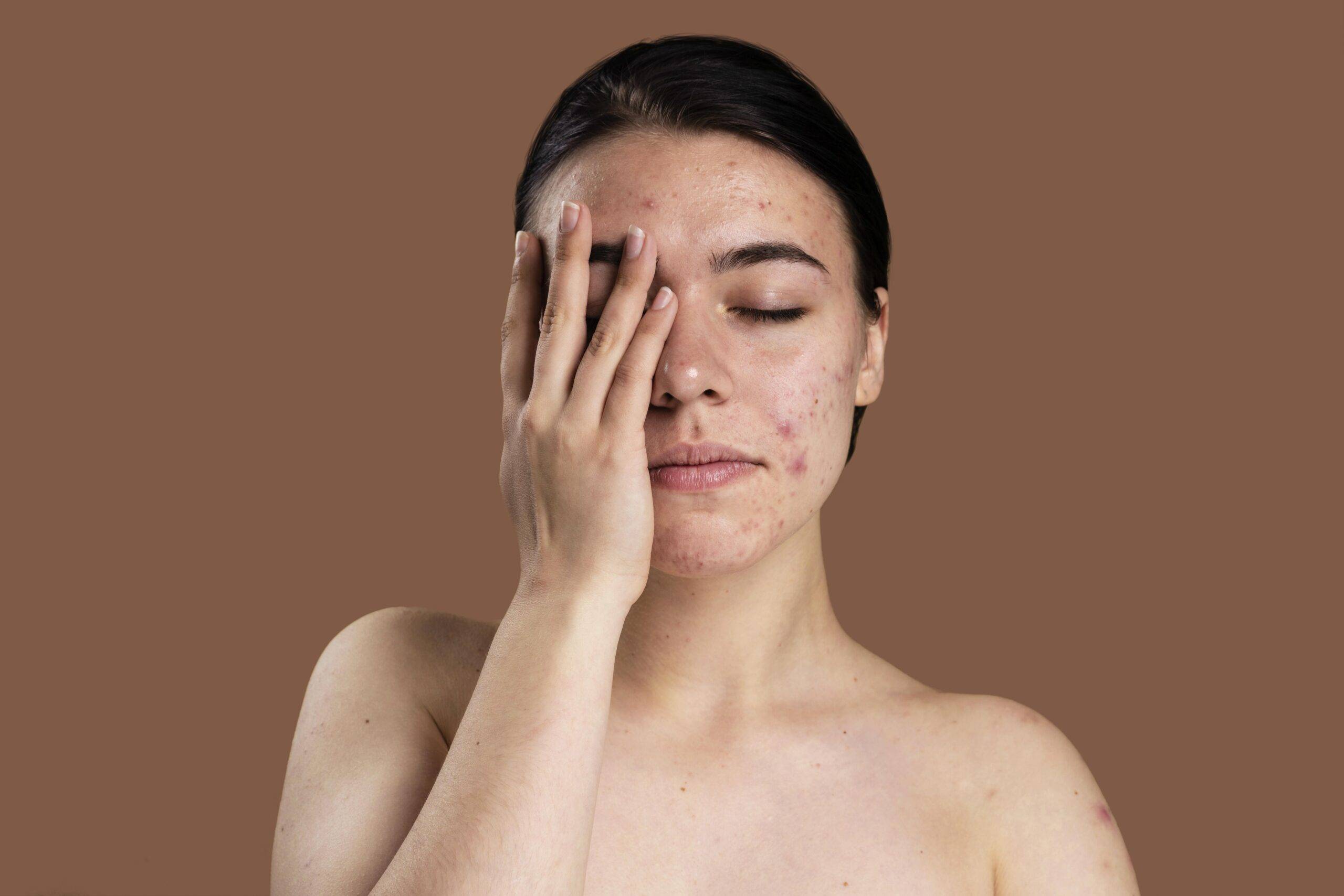 Acne Scars Vs. Pigmentation: How to Tell the Difference and Treat Them Right
