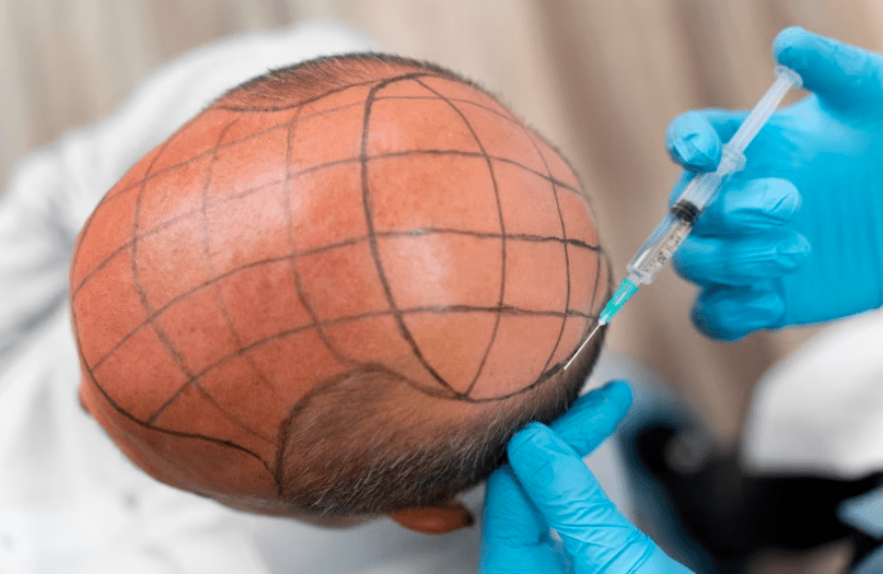 Best Hair Transplant Treatment