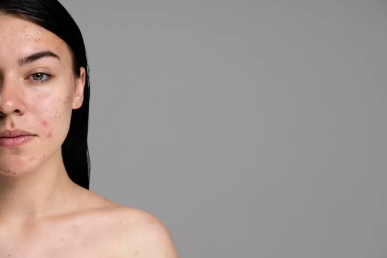 Five Acne Treatments That Work