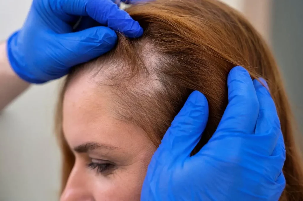 Reverse Balding