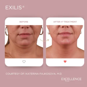 Exilis Elite result
