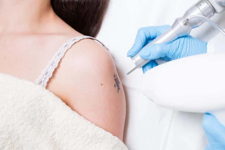 Regretting Your Tattoo? Remove It Instantly With a Permanent tattoo removal