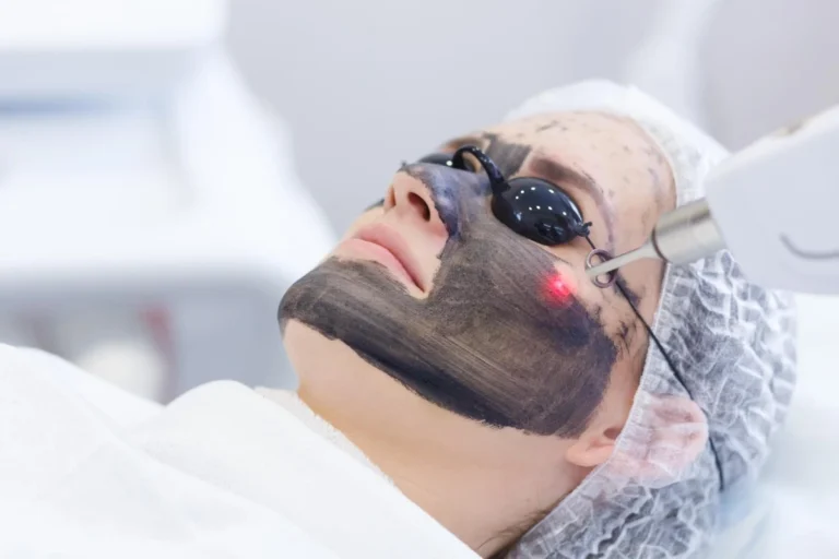 Everything You Need to Know About a Carbon Laser Facial