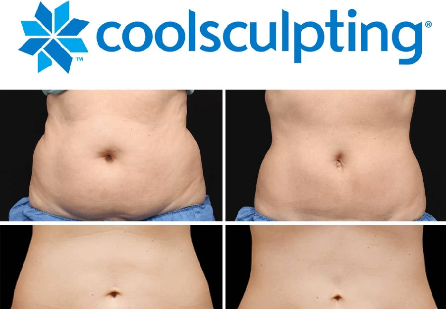 coolsulpting