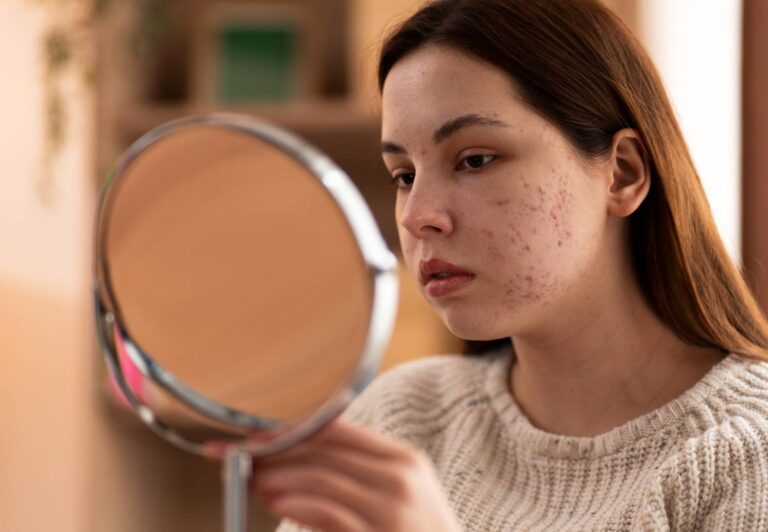 Dermatologist’s View on Acne Scars: Causes, Types & Best Treatments