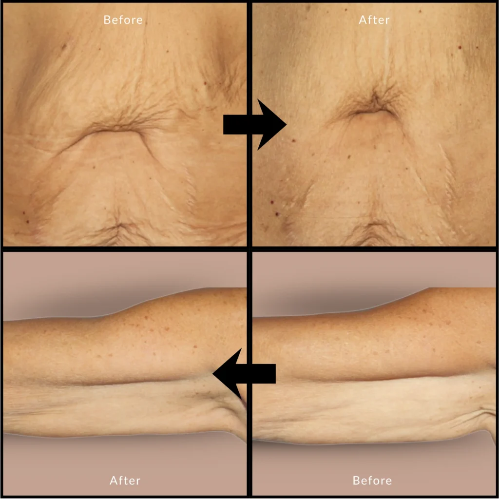 Profhilo Before and After