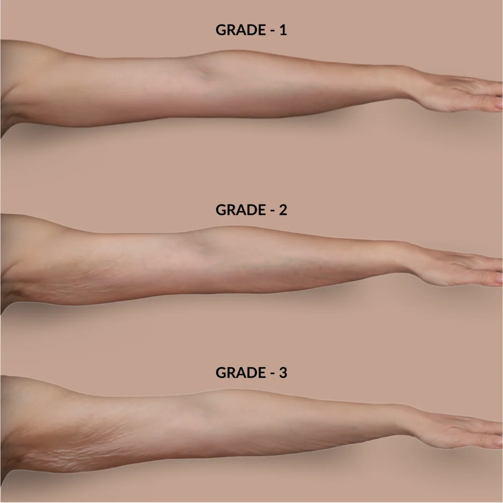 Profhilo - Comparison Arm